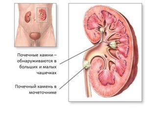 Операція з видалення каменів у нирках методи дроблення, усунення причин каменеутворення