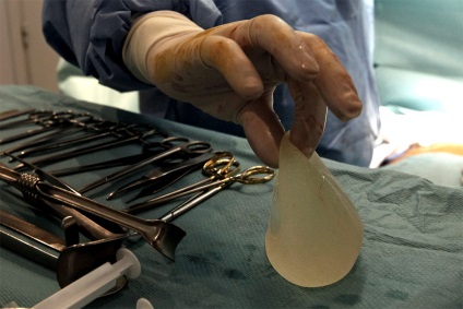 Operația de înlocuire a implanturilor mamare substandard pip - știri în fotografii