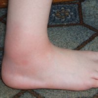 Пухлина на нозі у дитини