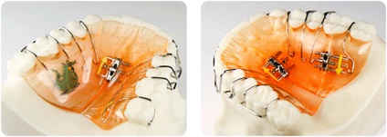 Ортодонтичне лікування знімними апаратами в москві