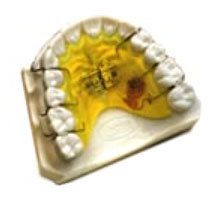 Ортодонтичне лікування з застосуванням знімною апаратури - ортодонтія