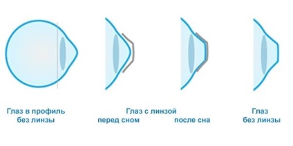 Orthokeratologie - o tehnică pentru corectarea vederii nocturne