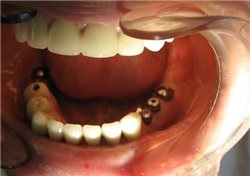 Caracteristici ale implantării dinților maxilarului inferior