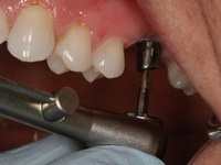 Особливості протезування жувальних зубів