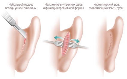 Otoplastia - ceea ce este, indicarea plasticii urechilor - chirurgie plastica