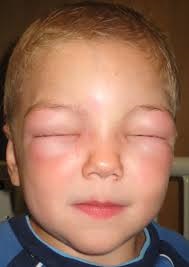 De alergii patogene pentru copii, alergii