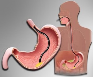 Nutriție după îndepărtarea stomacului - meniu, mâncare, mâncăruri dietetice