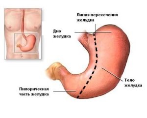 Харчування після видалення шлунка - меню, продукти, дієтичні страви