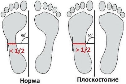 Плоскостопість причини, ознаки, симптоми, лікування і профілактика