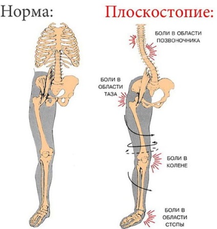 Плоскостопість причини, ознаки, симптоми, лікування і профілактика