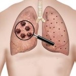 Pneumocicoza - simptome, diagnostic, tratament