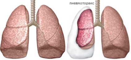 Cauzele pneumotoraxului, simptomele, diagnosticul, prevenirea și tratamentul