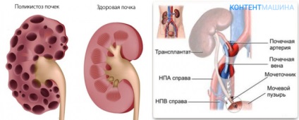 Simptomatologie renală polichistică și tratamentul bolii