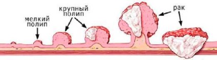 Polipi ai tractului gastro-intestinal