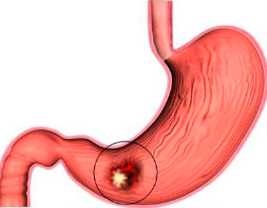 Polipi ai tractului gastro-intestinal