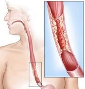 Polipi ai tractului gastro-intestinal