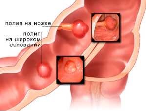 Polipi ai tractului gastro-intestinal