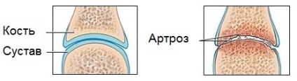 Preparate chondroprotectoare pentru tratamentul artritei articulare