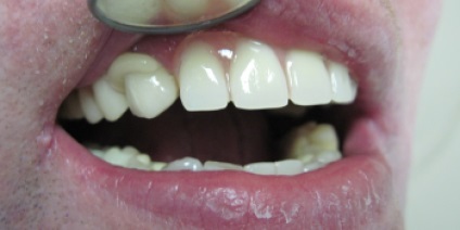 Протезування зубів иркутск ціни, відгуки, адреси стоматології