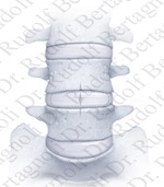 Протез міжхребцевого диска в шийному хребці