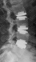 Proteza discului intervertebral în vertebra cervicală