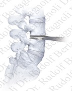Proteza discului intervertebral în vertebra cervicală