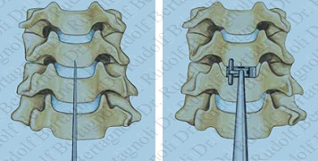 Proteza discului intervertebral în vertebra cervicală