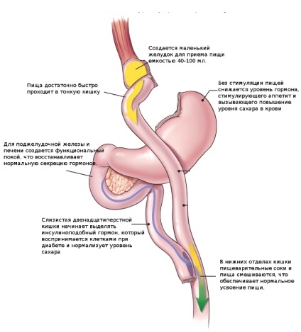 Tratamentul radical al diabetului zaharat