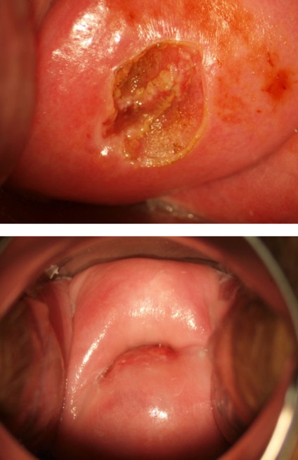 Rádióhullámos kezelés méhnyak erózió - a választás a nőgyógyászok és a betegek
