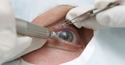 Simptomele și tratamentul cancerului de ochi