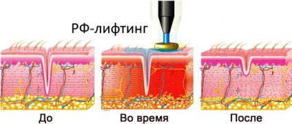 Росії-ліфтинг особи