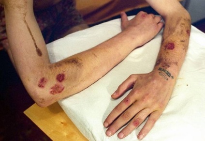 Sifilis pe mâini - fotografii ale sifilisului pe mâini