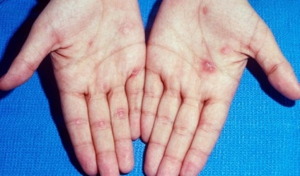Сифіліс на руках - фото симптомів сифілісу на руках