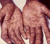 Sifilis pe mâini (palme) chancroid, erupție sifilistică