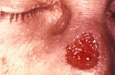 Syphiloma (смолисто syphiloderm)