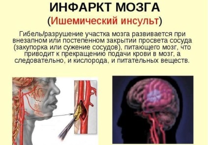 Simptomele unui cheag de sânge în cap