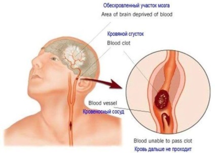 Симптоми тромбу в голові