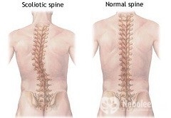 Scolioza - grade, clasificare, tratament, prevenire