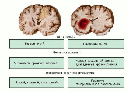 Середній інсульт - лікування серця