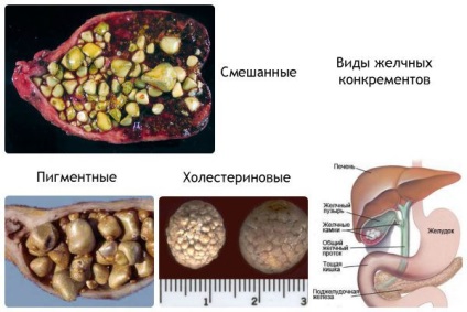 Plante medicinale după îndepărtarea vezicii biliare, care, cum și de ce să luați