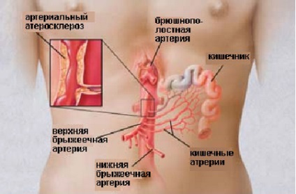 Тромбоз кишечника причини і стадії небезпечного захворювання