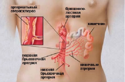 Tromboza cauzelor intestinului și etapele unei boli periculoase