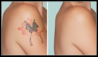 Видалення татуювання на плечі шліфування або лазер