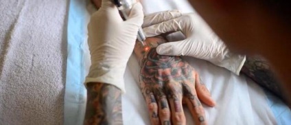 Pregătirea, îndepărtarea, îngrijirea și vindecarea cu laser a tatuajelor