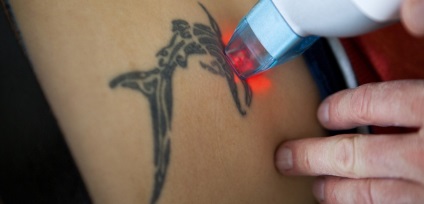 Pregătirea, îndepărtarea, îngrijirea și vindecarea cu laser a tatuajelor