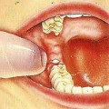 Видалення зуба як довго заживає рана
