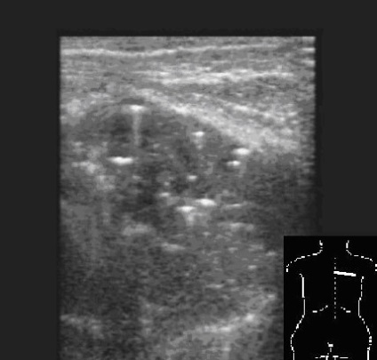 Diagnosticarea ultrasonică a acumulărilor patologice de aer în cavitatea pleurală și în plămâni