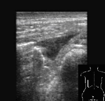 Diagnosticarea ultrasonică a acumulărilor patologice de aer în cavitatea pleurală și în plămâni