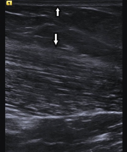 Ecografie musculară în normă și cu patologie neuromusculară - dalyagin în
