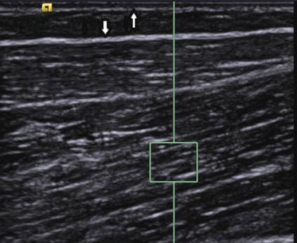 Ecografie musculară în normă și cu patologie neuromusculară - dalyagin în